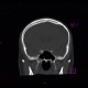 Arachnoid cyst, frontal lobe: CT - Computed tomography